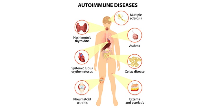 Illustration of effect of autoimmune disease on development of hypothyroidism